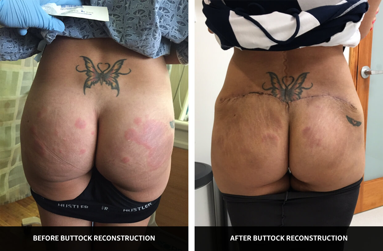 Case Study 01 - before and after photos of buttock reconstruction by Dr. Mir
