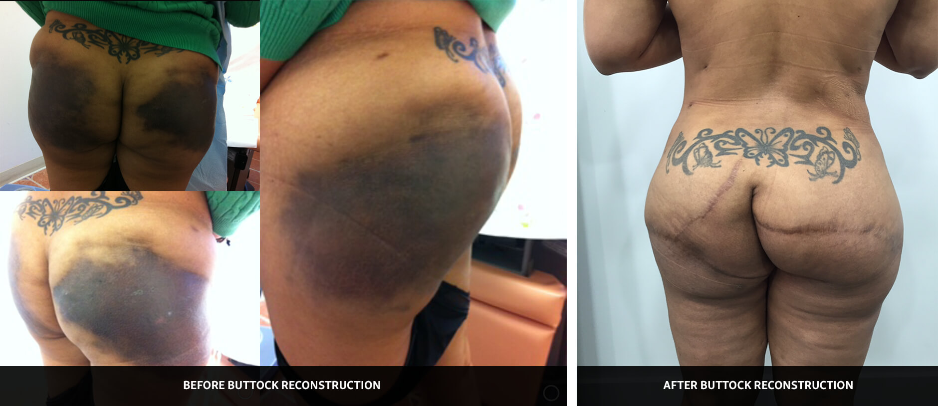 Case Study 02 - before and after photos of buttock reconstruction by Dr. Mir