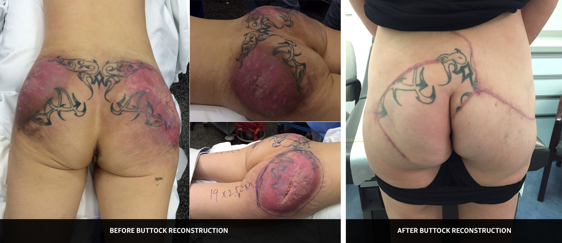 Case Study 03 - before and after photos of buttock reconstruction by Dr. Mir